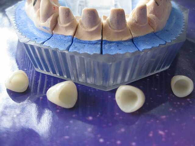 烤瓷牙中的全瓷牙 不含金属 对牙龈无刺激 色泽